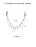 MINIMALLY INVASIVE BREAST LIFT METHOD WITH A SUPERIOR TISSUE SUPPORT AND     AN INFERIOR ANCHOR diagram and image