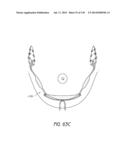 MINIMALLY INVASIVE BREAST LIFT METHOD WITH A SUPERIOR TISSUE SUPPORT AND     AN INFERIOR ANCHOR diagram and image