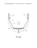 MINIMALLY INVASIVE BREAST LIFT METHOD WITH A SUPERIOR TISSUE SUPPORT AND     AN INFERIOR ANCHOR diagram and image