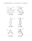 MINIMALLY INVASIVE BREAST LIFT METHOD WITH A SUPERIOR TISSUE SUPPORT AND     AN INFERIOR ANCHOR diagram and image