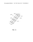 MINIMALLY INVASIVE BREAST LIFT METHOD WITH A SUPERIOR TISSUE SUPPORT AND     AN INFERIOR ANCHOR diagram and image