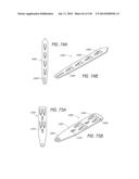 MINIMALLY INVASIVE BREAST LIFT METHOD WITH A SUPERIOR TISSUE SUPPORT AND     AN INFERIOR ANCHOR diagram and image