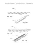 MINIMALLY INVASIVE BREAST LIFT METHOD WITH A SUPERIOR TISSUE SUPPORT AND     AN INFERIOR ANCHOR diagram and image