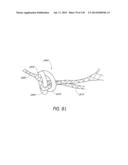 MINIMALLY INVASIVE BREAST LIFT METHOD WITH A SUPERIOR TISSUE SUPPORT AND     AN INFERIOR ANCHOR diagram and image