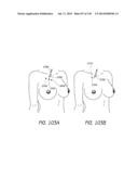 MINIMALLY INVASIVE BREAST LIFT METHOD WITH A SUPERIOR TISSUE SUPPORT AND     AN INFERIOR ANCHOR diagram and image