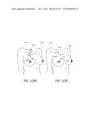 MINIMALLY INVASIVE BREAST LIFT METHOD WITH A SUPERIOR TISSUE SUPPORT AND     AN INFERIOR ANCHOR diagram and image