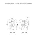 MINIMALLY INVASIVE BREAST LIFT METHOD WITH A SUPERIOR TISSUE SUPPORT AND     AN INFERIOR ANCHOR diagram and image