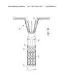 DIVERTICULUM INVERTING DEVICE diagram and image