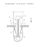 DIVERTICULUM INVERTING DEVICE diagram and image