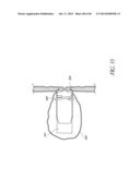 DIVERTICULUM INVERTING DEVICE diagram and image