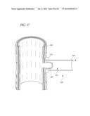 DIVERTICULUM INVERTING DEVICE diagram and image