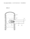 DIVERTICULUM INVERTING DEVICE diagram and image