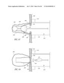 DIVERTICULUM INVERTING DEVICE diagram and image