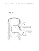 DIVERTICULUM INVERTING DEVICE diagram and image