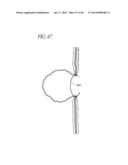 DIVERTICULUM INVERTING DEVICE diagram and image