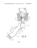 SYSTEMS AND METHODS FOR TREATING DYSFUNCTIONS IN THE INTESTINES AND RECTUM     THAT ADAPT TO THE ANATOMIC FORM AND STRUCTURE OF DIFFERENT INDIVIDUALS diagram and image