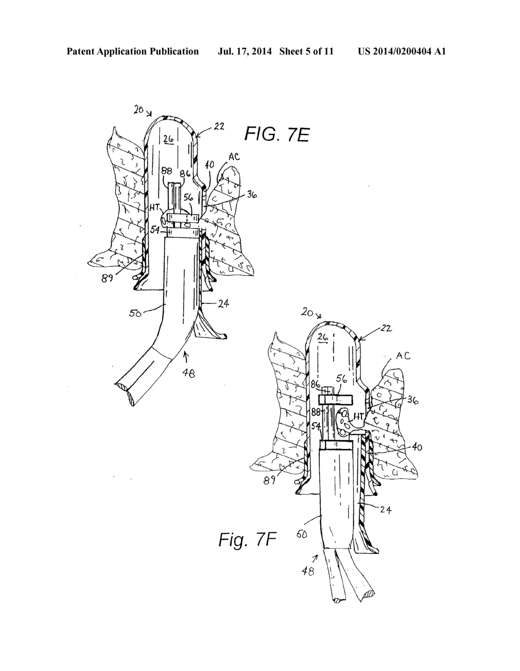 TREATMENT METHOD INCLUDING TISSUE OCCLUSION DEVICE - diagram, schematic, and image 06