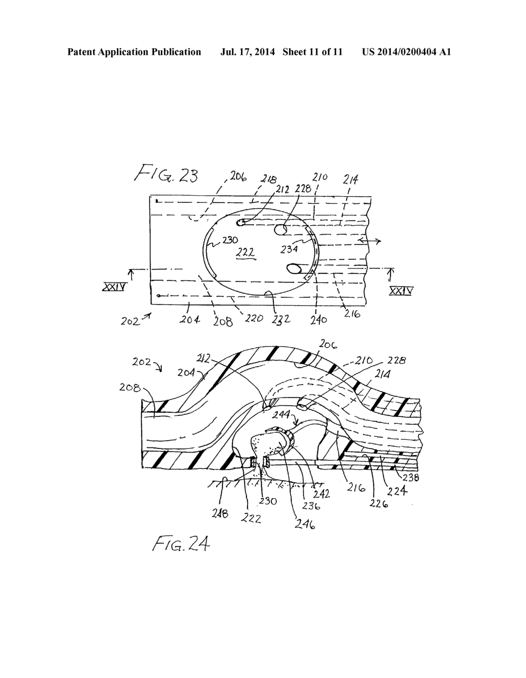 TREATMENT METHOD INCLUDING TISSUE OCCLUSION DEVICE - diagram, schematic, and image 12