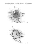 METHODS OF ORIENTING AND REGISTERING DURING A SURGICAL PROCEDURE diagram and image