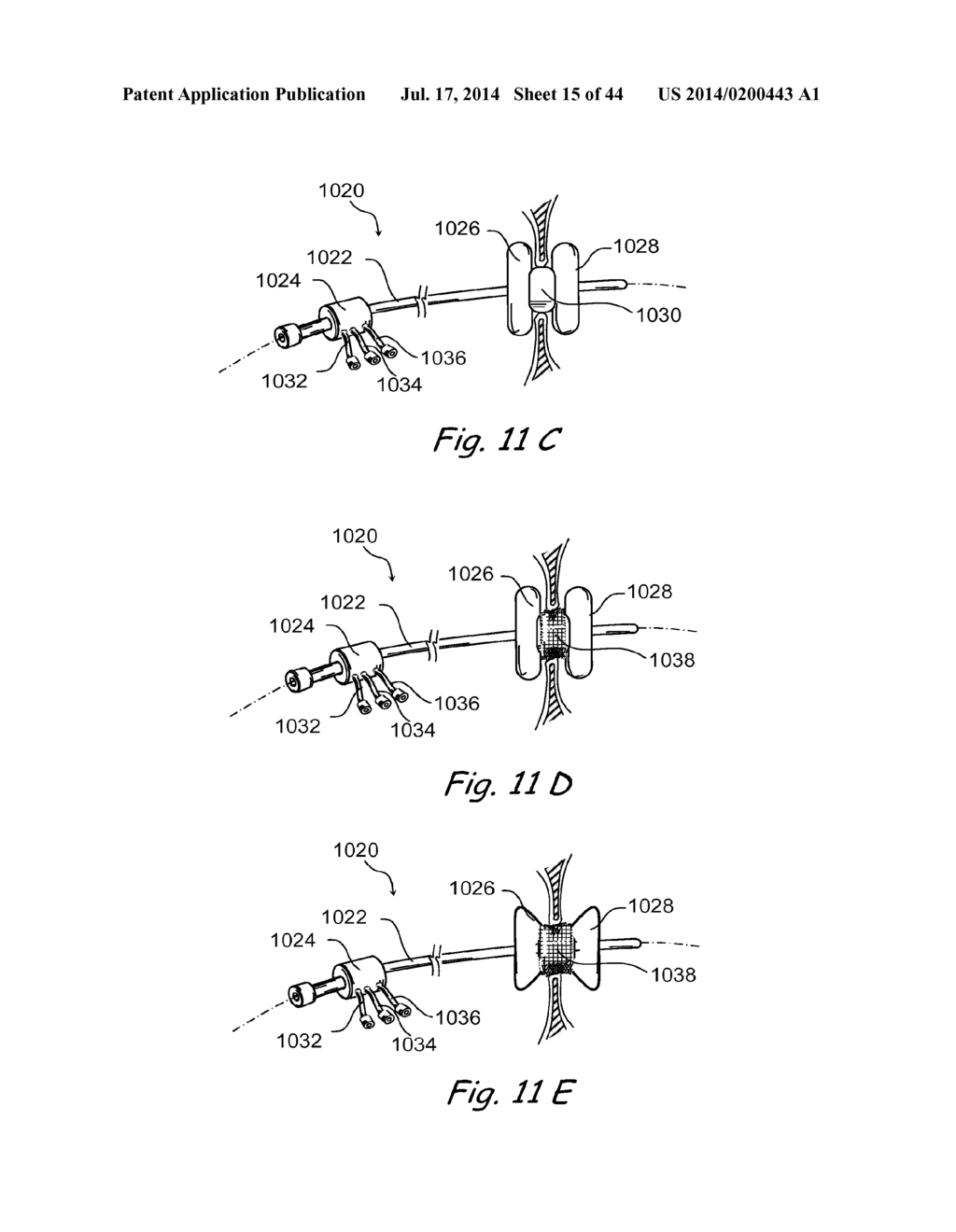 DEVICES, SYSTEMS AND METHODS FOR TREATING DISORDERS OF THE EAR, NOSE AND     THROAT - diagram, schematic, and image 16