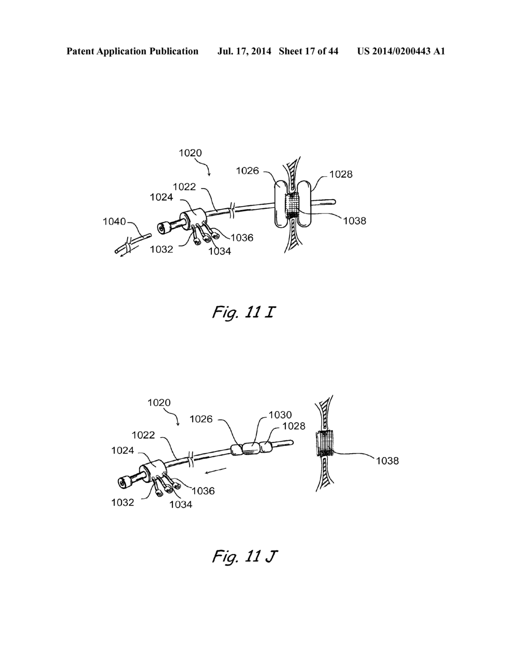 DEVICES, SYSTEMS AND METHODS FOR TREATING DISORDERS OF THE EAR, NOSE AND     THROAT - diagram, schematic, and image 18