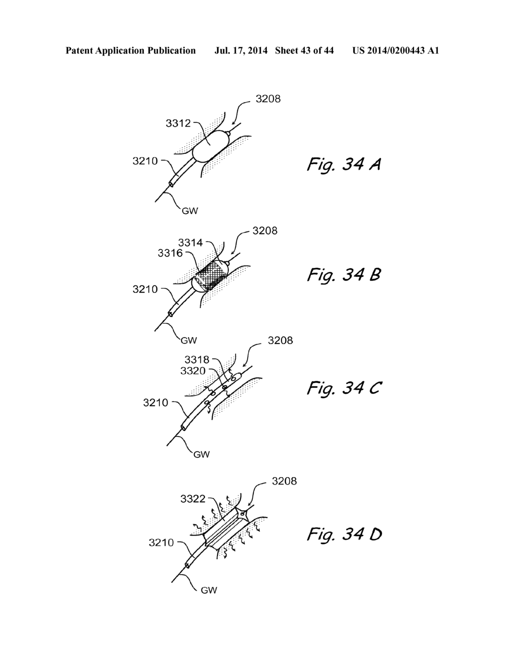 DEVICES, SYSTEMS AND METHODS FOR TREATING DISORDERS OF THE EAR, NOSE AND     THROAT - diagram, schematic, and image 44