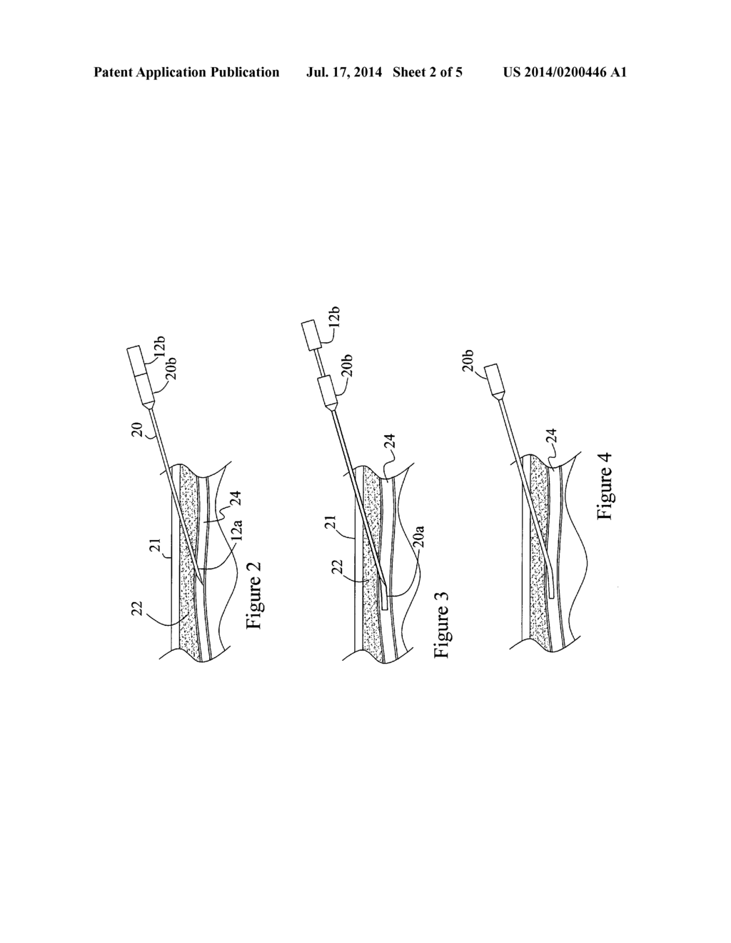 Method and apparatus for the infusion of a catheter into an artery/vein     and for suspected tissue removal - diagram, schematic, and image 03