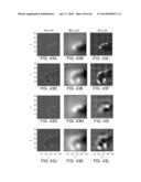 METHODS AND SYSTEMS FOR DETERMINING SPATIOTEMPORAL VARIABILITY FOR MAPPING     CARDIAC FIBRILLATION diagram and image