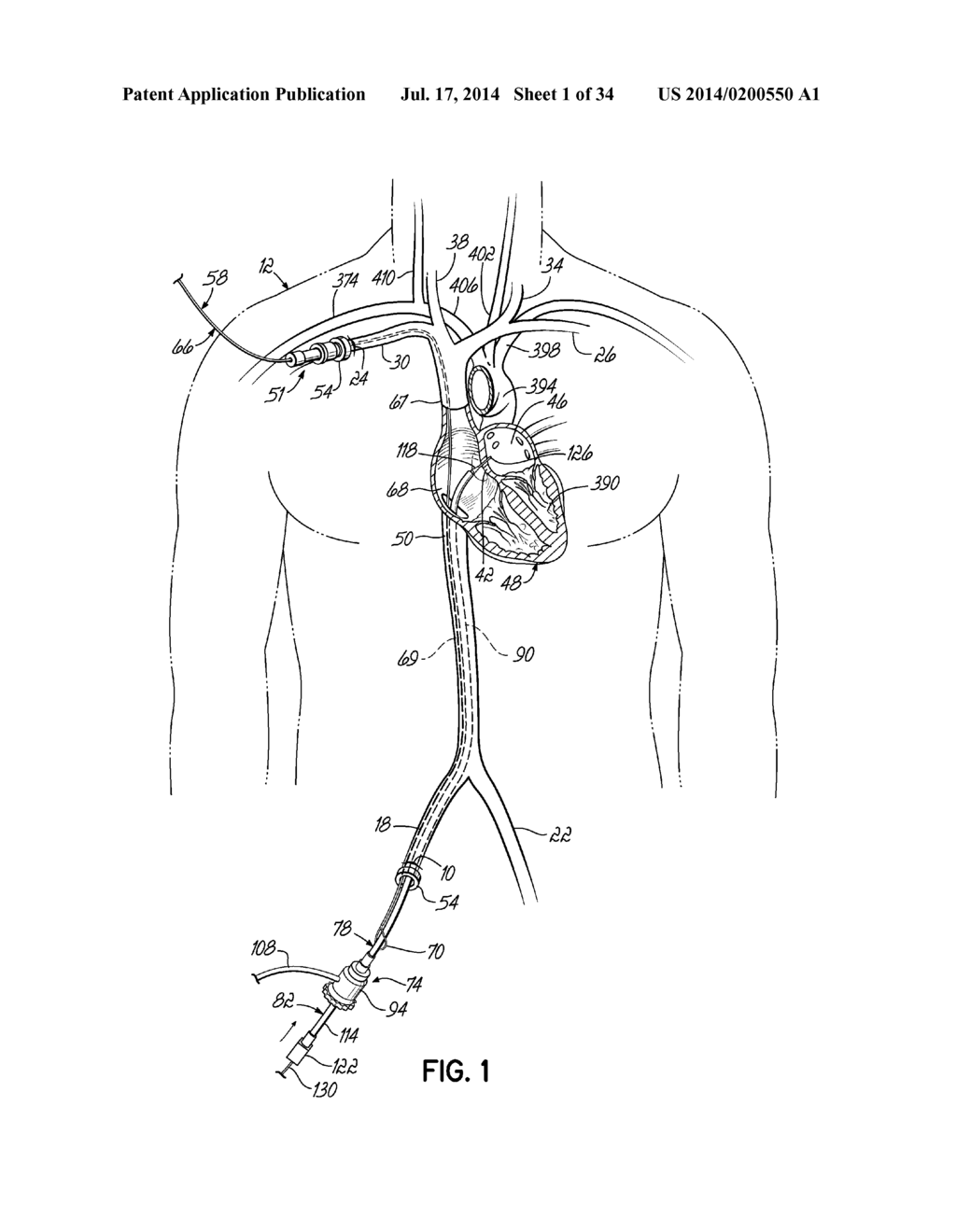 TWO-PIECE TRANSSEPTAL CANNULA, DELIVERY SYSTEM, AND METHOD OF DELIVERY - diagram, schematic, and image 02
