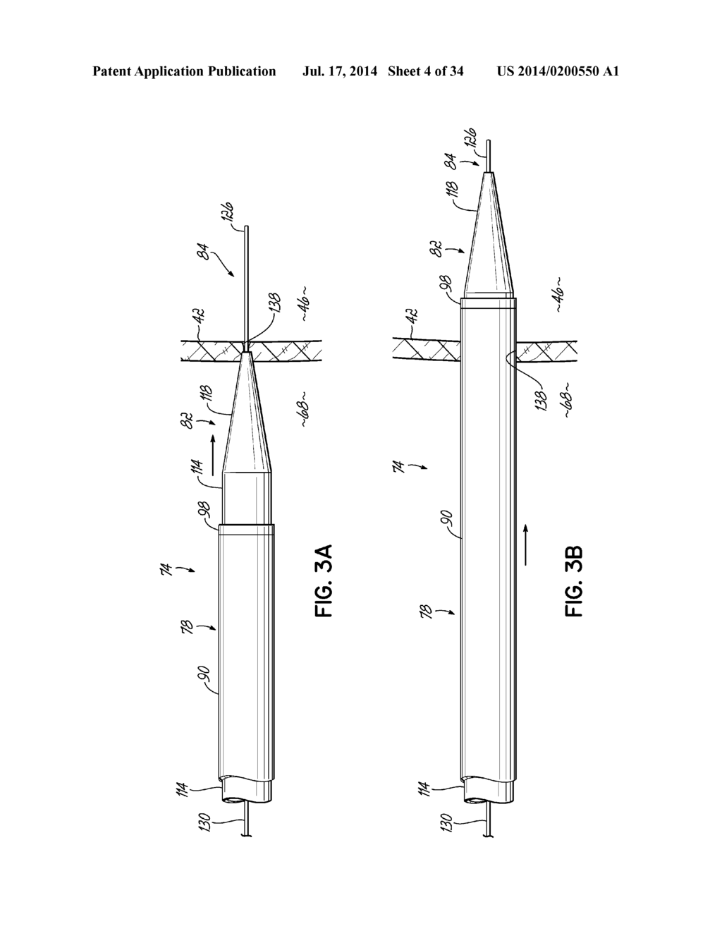 TWO-PIECE TRANSSEPTAL CANNULA, DELIVERY SYSTEM, AND METHOD OF DELIVERY - diagram, schematic, and image 05