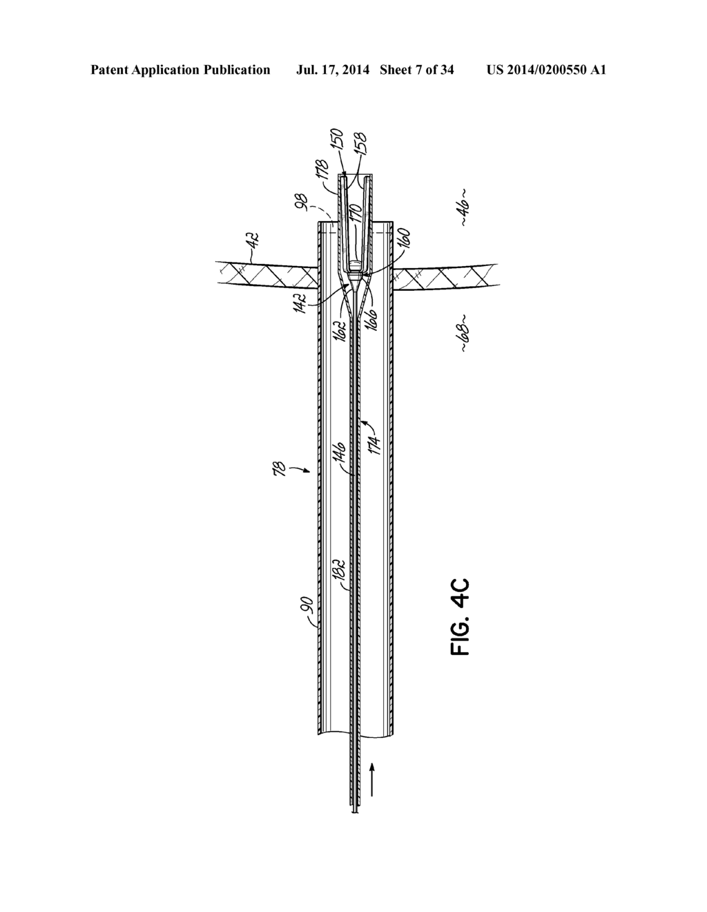 TWO-PIECE TRANSSEPTAL CANNULA, DELIVERY SYSTEM, AND METHOD OF DELIVERY - diagram, schematic, and image 08