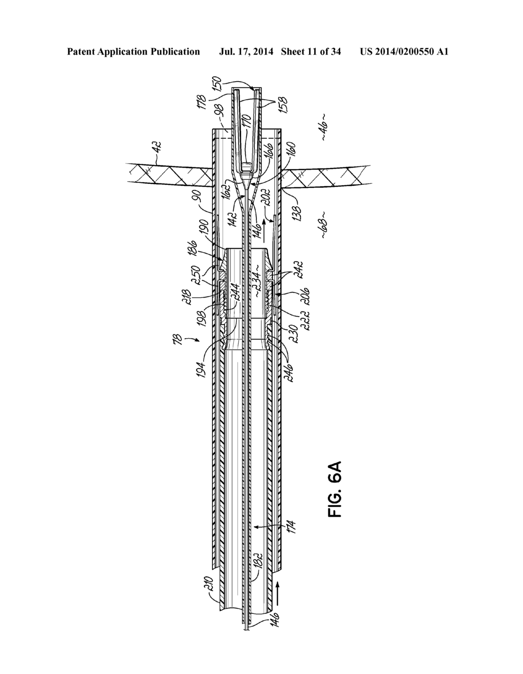 TWO-PIECE TRANSSEPTAL CANNULA, DELIVERY SYSTEM, AND METHOD OF DELIVERY - diagram, schematic, and image 12