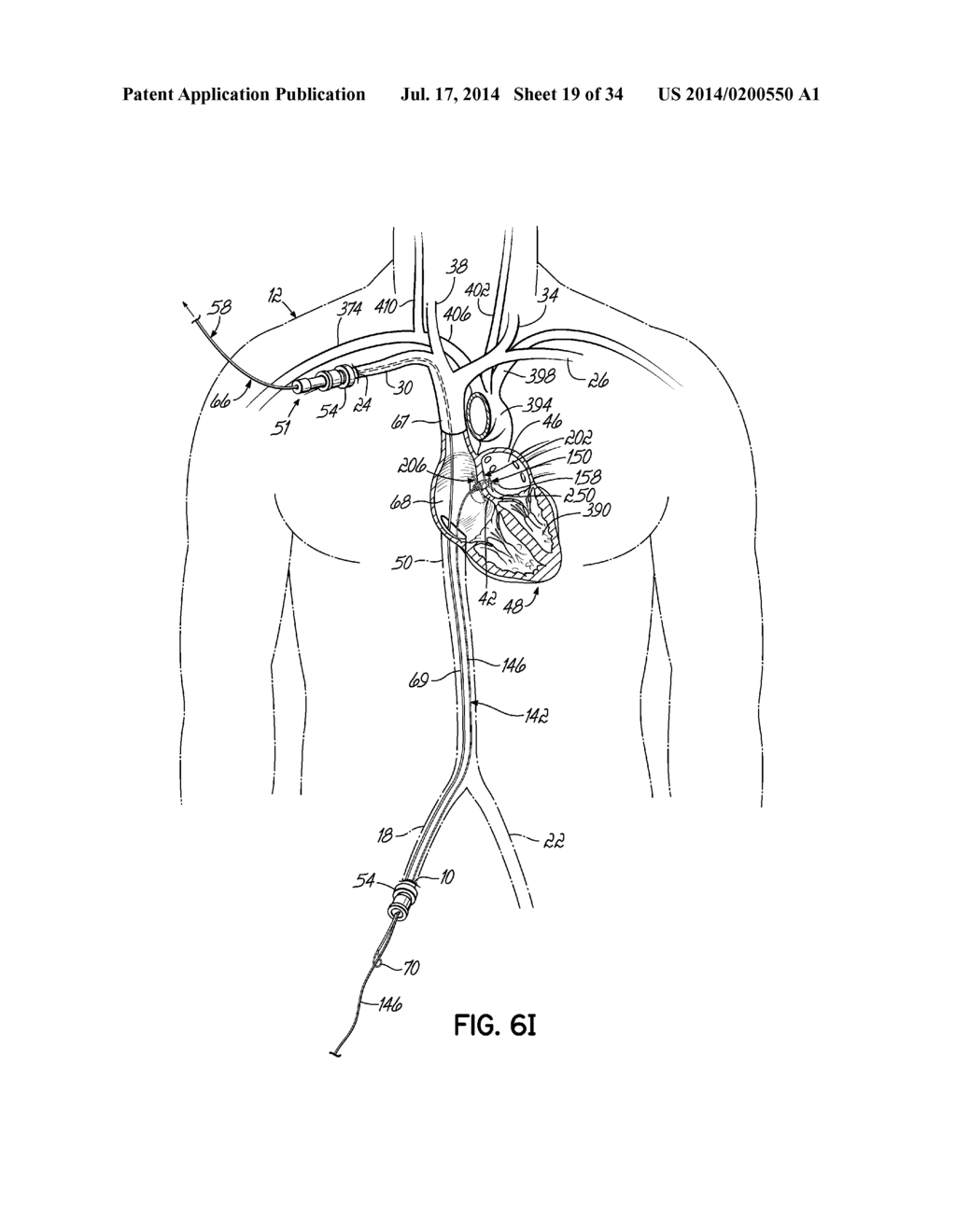 TWO-PIECE TRANSSEPTAL CANNULA, DELIVERY SYSTEM, AND METHOD OF DELIVERY - diagram, schematic, and image 20