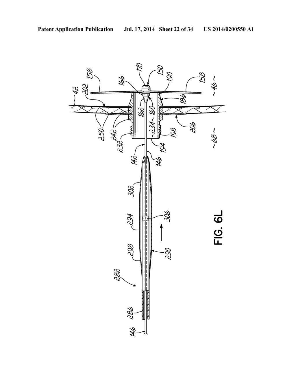 TWO-PIECE TRANSSEPTAL CANNULA, DELIVERY SYSTEM, AND METHOD OF DELIVERY - diagram, schematic, and image 23