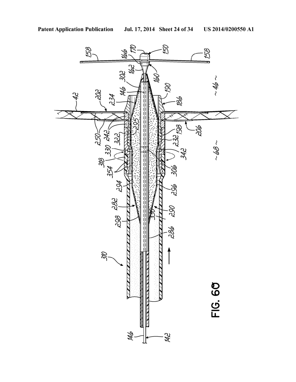 TWO-PIECE TRANSSEPTAL CANNULA, DELIVERY SYSTEM, AND METHOD OF DELIVERY - diagram, schematic, and image 25