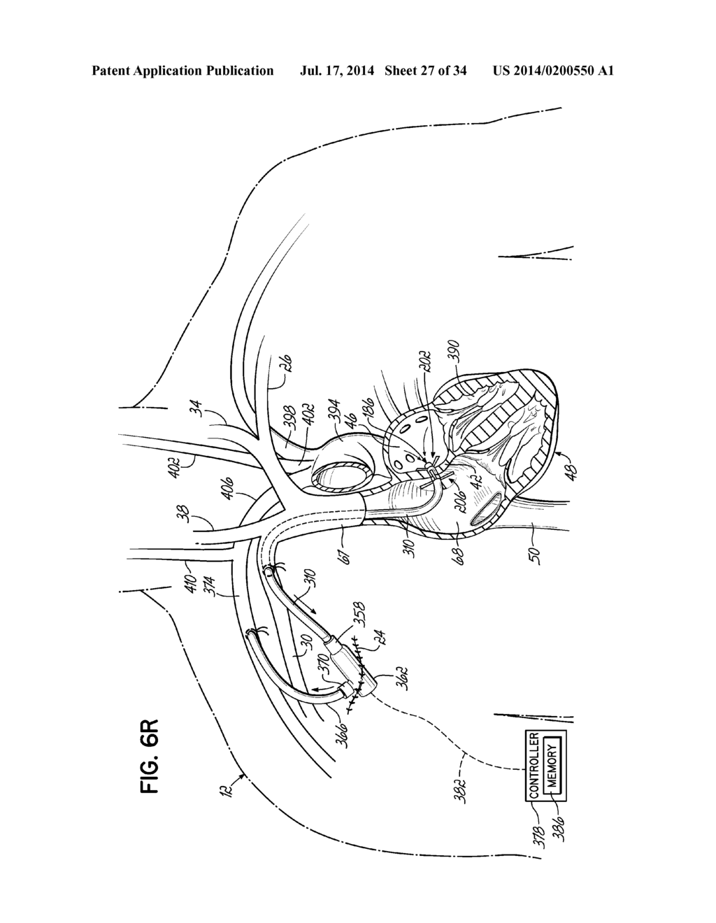 TWO-PIECE TRANSSEPTAL CANNULA, DELIVERY SYSTEM, AND METHOD OF DELIVERY - diagram, schematic, and image 28