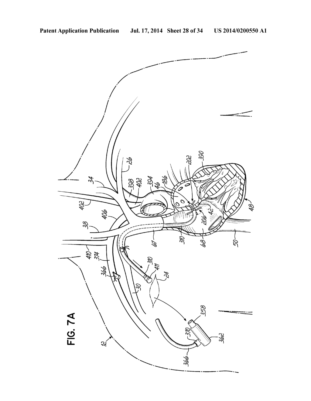 TWO-PIECE TRANSSEPTAL CANNULA, DELIVERY SYSTEM, AND METHOD OF DELIVERY - diagram, schematic, and image 29