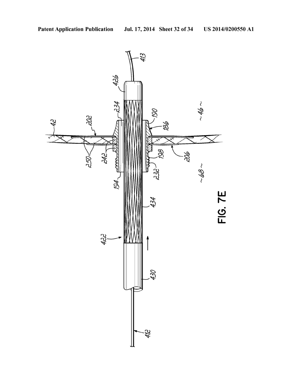 TWO-PIECE TRANSSEPTAL CANNULA, DELIVERY SYSTEM, AND METHOD OF DELIVERY - diagram, schematic, and image 33