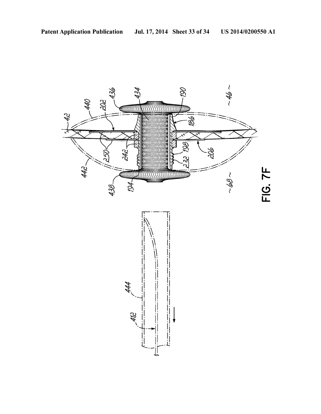 TWO-PIECE TRANSSEPTAL CANNULA, DELIVERY SYSTEM, AND METHOD OF DELIVERY - diagram, schematic, and image 34