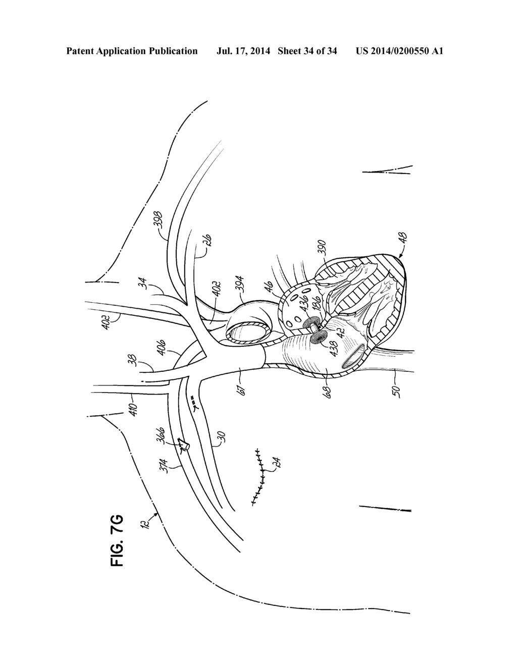 TWO-PIECE TRANSSEPTAL CANNULA, DELIVERY SYSTEM, AND METHOD OF DELIVERY - diagram, schematic, and image 35