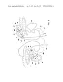 Method and Apparatus for Tissue Ablation diagram and image