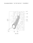 Method and Apparatus for Tissue Ablation diagram and image