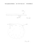 FISTULA TREATMENT DEVICES AND METHODS diagram and image