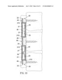 Anti-Displacement Coil Spring-Type Spine Stabilization Device diagram and image