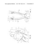 INTERMITTENT NEURAL STIMULATION WITH PHYSIOLOGIC RESPONSE MONITOR diagram and image