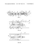 METHODS AND APPARATUS FOR LUMINAL STENTING diagram and image