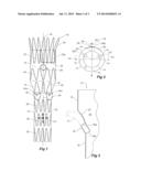 PARARENAL STENT GRAFT diagram and image