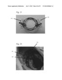 ANCHORING ELEMENTS FOR INTRACARDIAC DEVICES diagram and image