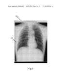 METHOD FOR IMPROVED DETECTION OF NODULES IN MEDICAL IMAGES diagram and image