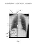 METHOD FOR IMPROVED DETECTION OF NODULES IN MEDICAL IMAGES diagram and image